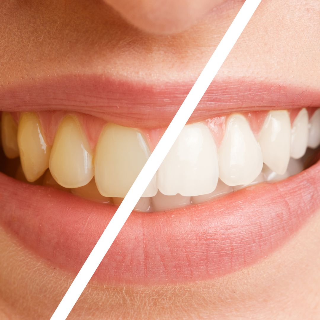 😁 AQUADENT - Irrigador Dental: Dientes limpios, saludables y blancos + 1 Cepillo Dental 20.000 Cerdas + 1 Cupón de 10% de descuento para limpieza dental de🎁REGALO